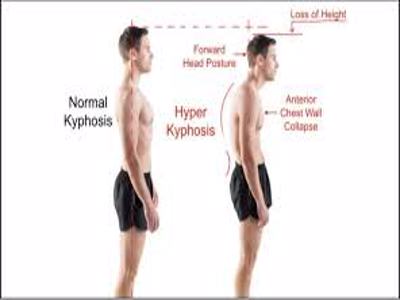 kyphosis disorder