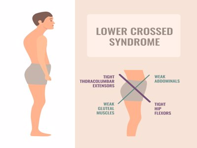 Lower Cross Syndrome