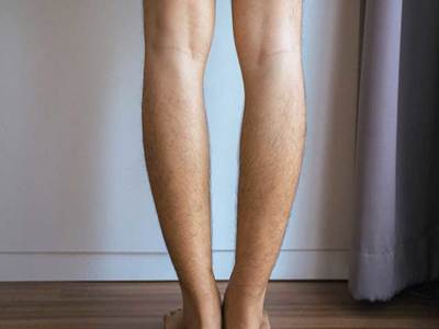 Tibia Vara