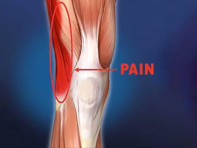 runner's knee