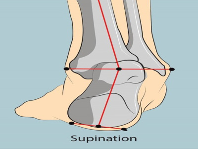 Supinated foot
