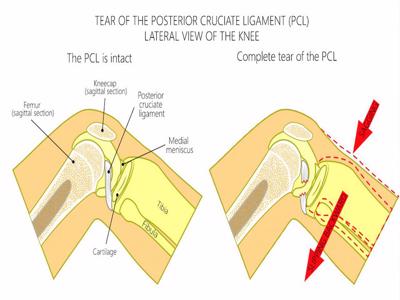 Posterior cruciate ligament