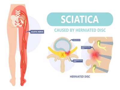 lumbar disc herniation